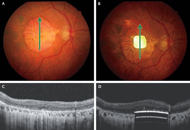 Oko pacienta pred a po implantácii špeciálneho fotovoltického čipu.